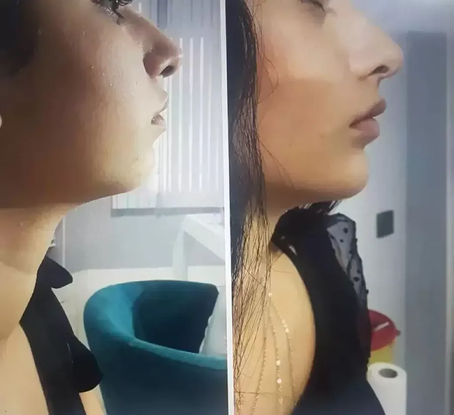 Çene Dolgusu