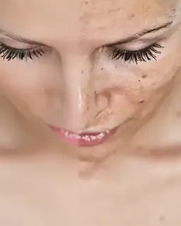 Leke Tedavisi