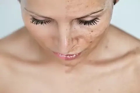 Leke Tedavisi