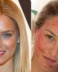 Vampire Facelift