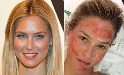 Vampire Facelift